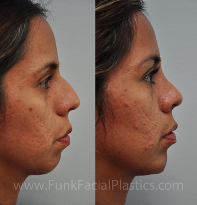 Hispanic nose job Houston