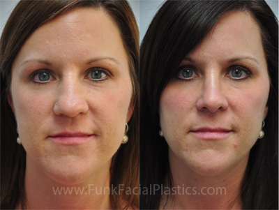 Rhinoplasty Houston