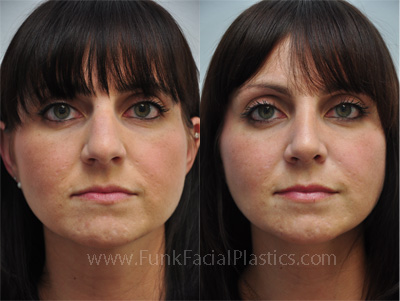 Nose job Houston by Dr. Funk