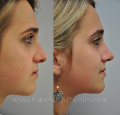 Nose Surgery Houston