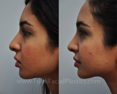 Nose Job Houston