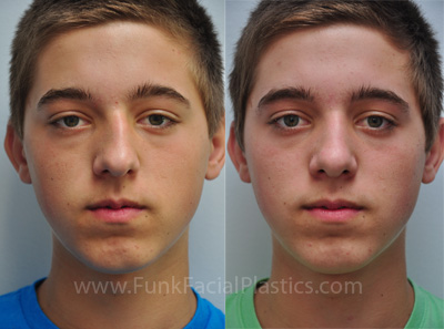 Male Rhinoplasty Houston