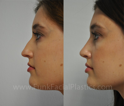 L profile before and after rhinoplasty