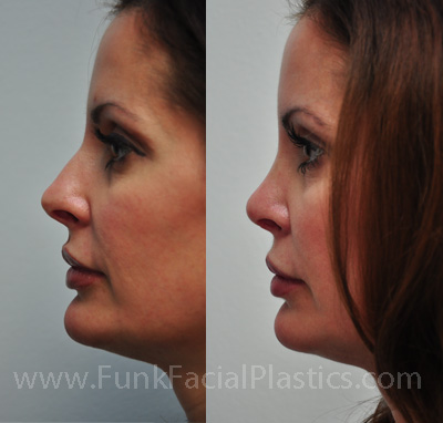 Best nose surgeon Houston