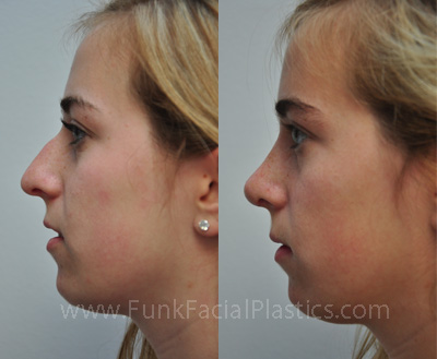 Deviated Septum Surgery Houston