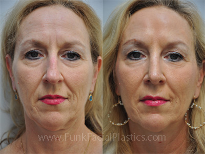 Top Nose Surgeon Houston