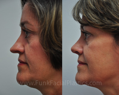 Top Nose Surgeon Houston