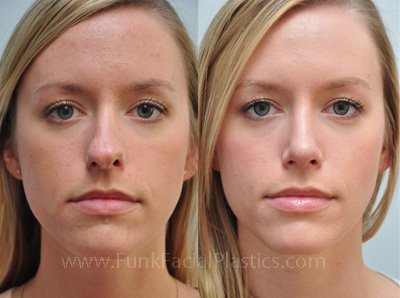 Best nose surgeon in Houston