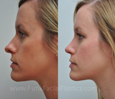 Deviated Septum Surgery Houston