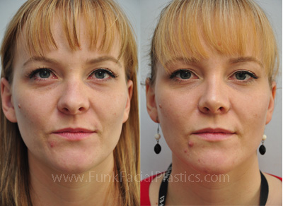 Top Rhinoplasty Surgeon in Texas