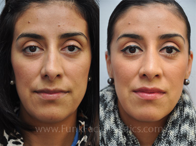 Deviated Septum surgery Houston