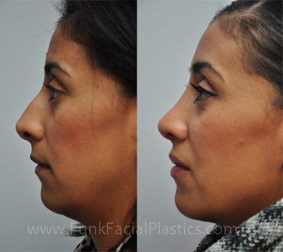 Top Nose Surgeon in Houston