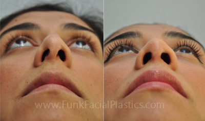 Nose surgery for uneven nostrils