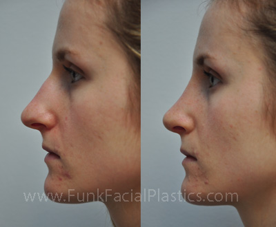 Top Rhinoplasty Surgeon in Houston