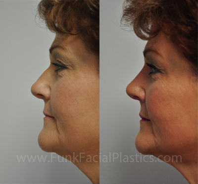 Rhinoplasty Houston