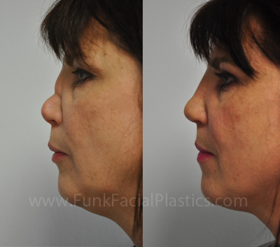 Rib Rhinoplasty Houston