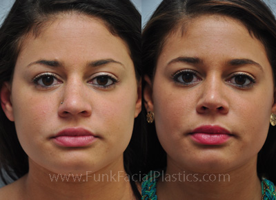 Nose Surgery for Crooked Nose in Houston