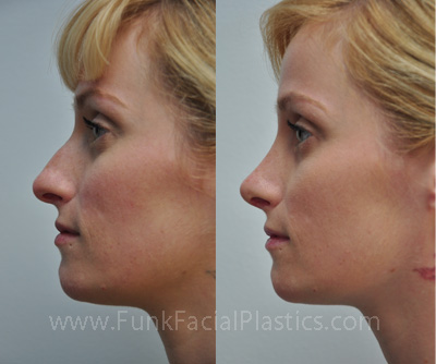 Best Doctor for Nose Surgery in Houston