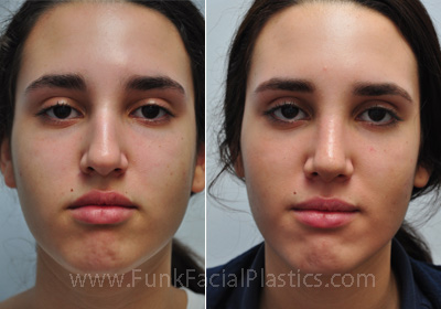 Top Rhinoplasty Surgeon in Texas