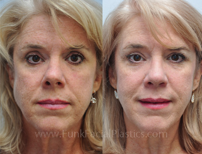 Top Nose Surgeon Houston