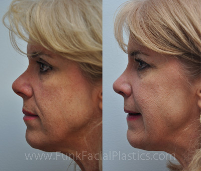 Rhinoplasty Houston