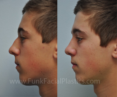 Rhinoplasty for a crooked nose Houston