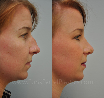 Best Nose Job Surgeon Houston