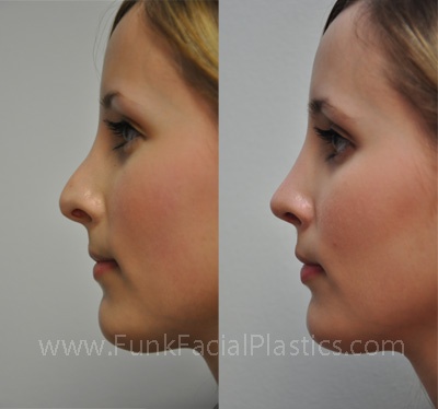 Nose Job Houston