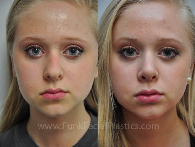 Nose surgery Houston