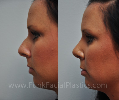 Rhinoplasty before and after photo