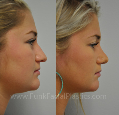 Rhinoplasty Houston