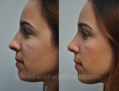 Rhinoplasty Surgeon in Houston