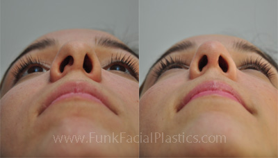 Rhinoplasty and Septoplasty for Uneven Nostrils 