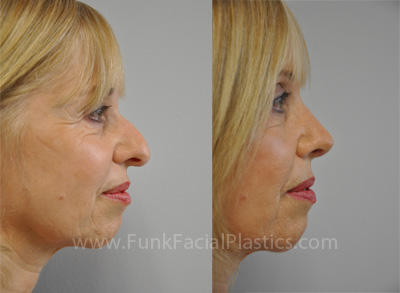 Right profile rhinoplasty patient