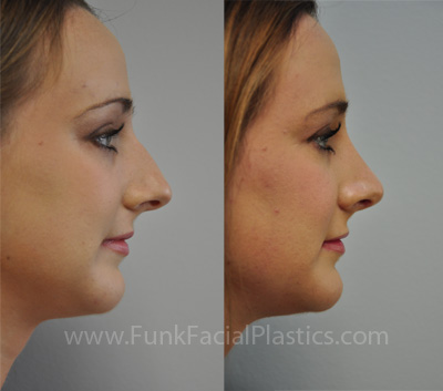 Nose surgery Houston