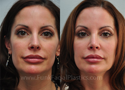 Crooked nose surgery Houston