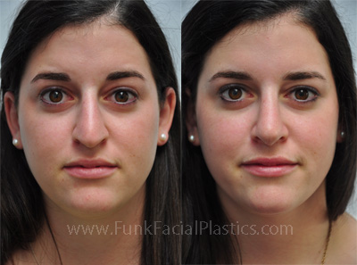 Nose surgery Houston