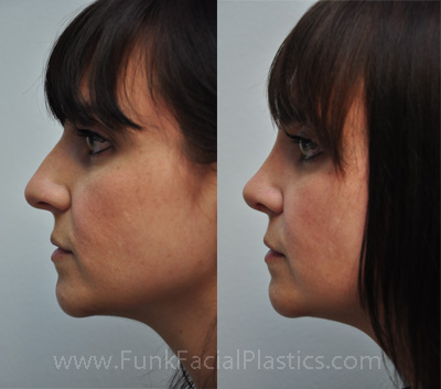 Rhinoplasty Houston Before and Afters