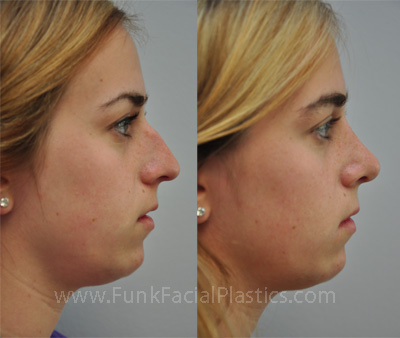 Nose Job Houston