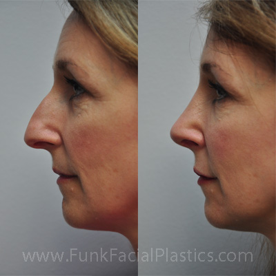 Top Nose Surgeon Houston