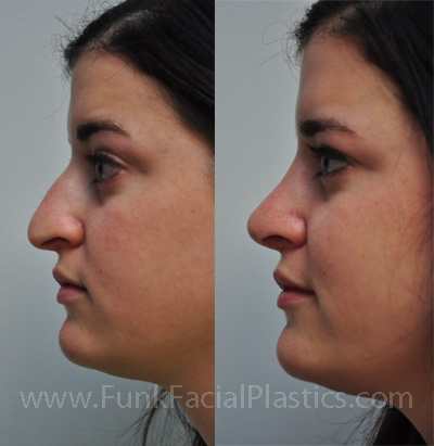 Nose Job Houston