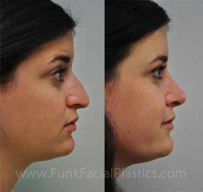 Rhinoplasty Houston