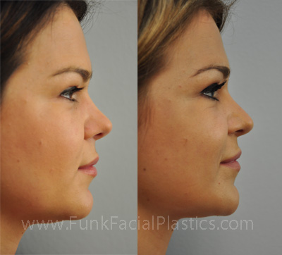 Best Nose Surgeon Houston