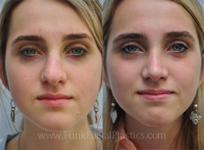 Rhinoplasty Houston before and after