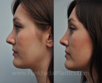 Revision rhinoplasty for Pollybeak Houston