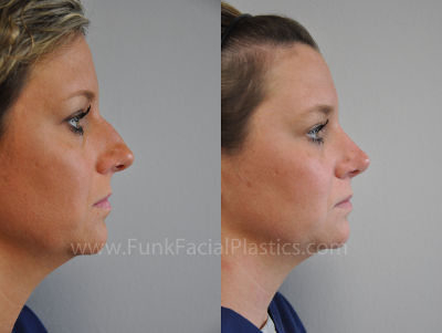 Rhinoplasty in Houston