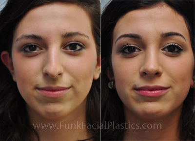 Rhinoplasty Houston