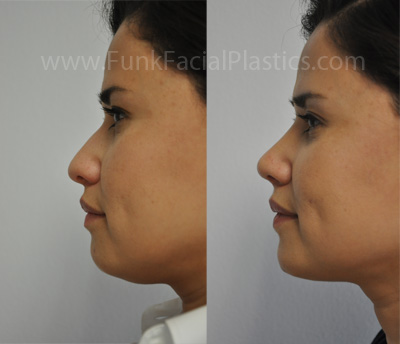 Neck Liposuction Houston