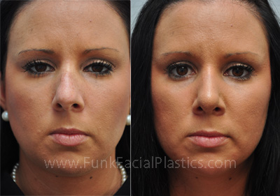 Nose surgeon Houston