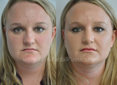 Nose surgery Houston TX